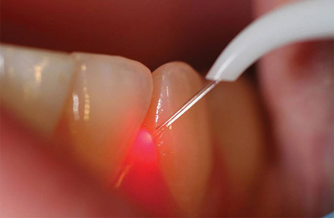 دندان کشیدن با لیزر